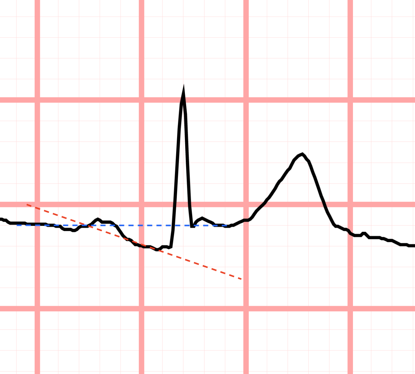 pr-depression-pericarditis